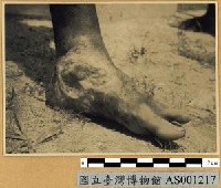 藏品(新幾內亞風土病寫真-熱帶潰瘍)的圖片